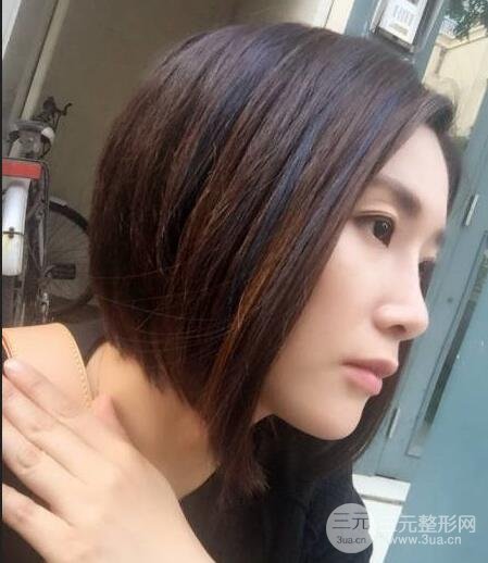 打完鼻子恢复的过程图，隆鼻案例日记分享