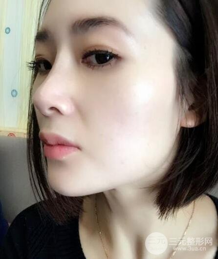 打完鼻子恢复的过程图，隆鼻案例日记分享