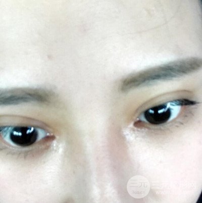 双眼皮多项整形整形案例：切开双眼皮+开内眼角前后对比图