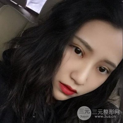 双眼皮多项整形整形案例：切开双眼皮+开内眼角前后对比图