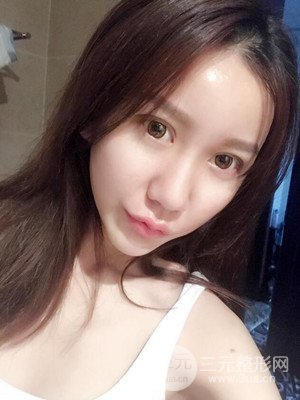 上海原辰自体脂肪填充案例，附上恢复过程以及对比图片
