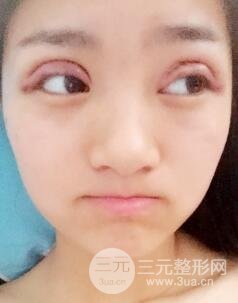 北京世熙宋玉龙全切双眼皮案例术后一个月恢复图片