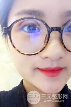 北京世熙宋玉龙全切双眼皮案例术后一个月恢复图片