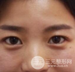 北京世熙宋玉龙全切双眼皮案例术后一个月恢复图片