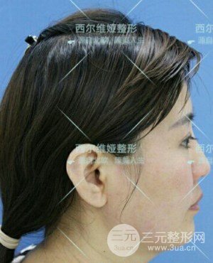全脸自体脂肪填充多久恢复自然？来看我的案例照片~