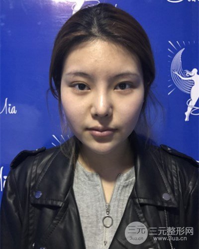 南京塑美颜李德庆切开割双眼皮一周果照片~