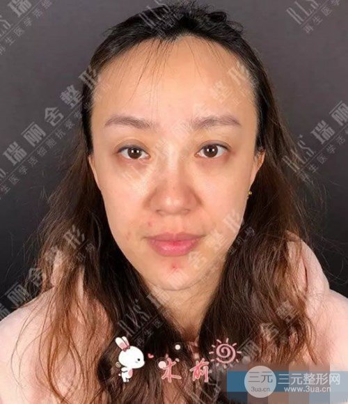 手术前脸颊凹陷严重的照片