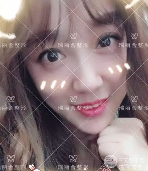 脸颊脂肪填充术后30天果