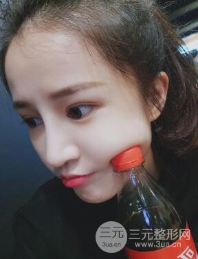 柏丽李劲良假体隆鼻案例果分享！小巧精致又立体~