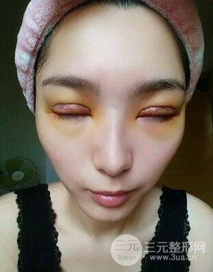 南通俪人整形双眼皮案例术后20天恢复真实图片分享~