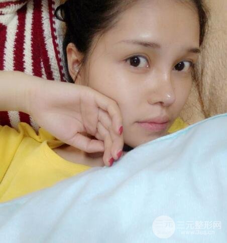 鼻头缩小术过程图，鼻头缩小恢复日记