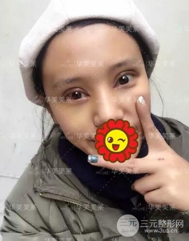 昆明华美杨继红全切双眼皮怎么样？真实案例图片分享~
