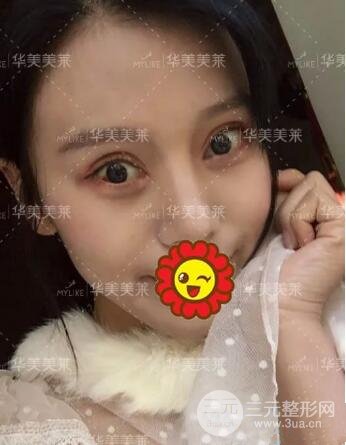 昆明华美杨继红全切双眼皮怎么样？真实案例图片分享~