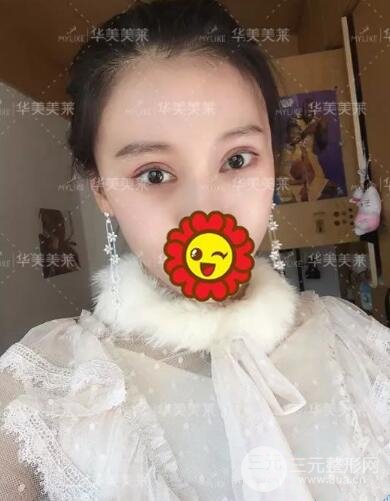 昆明华美杨继红全切双眼皮怎么样？真实案例图片分享~