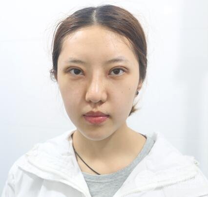 湘潭雅美张先智做的全切双眼皮+开眼角案例图片分享~