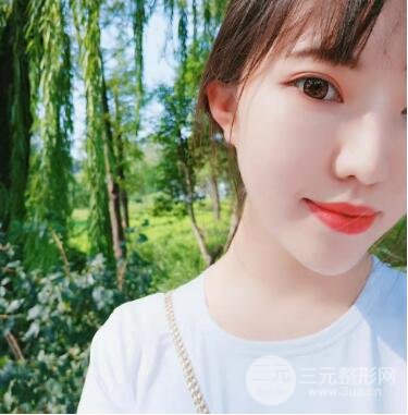 湘潭雅美张先智做的全切双眼皮+开眼角案例图片分享~