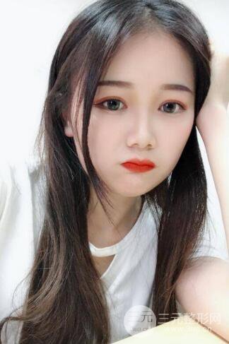 湘雅龙剑虹双眼皮案例恢复日记分享