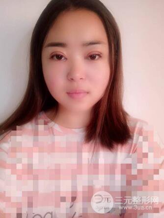 吴溯帆双眼皮案例图片日记真实分享