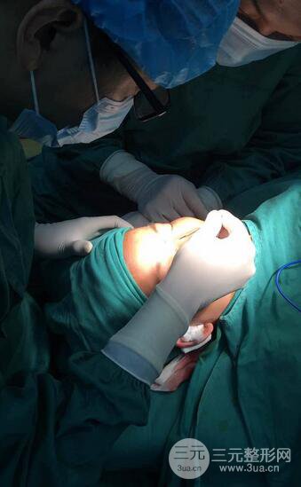 隆鼻鼻翼缩小全过程和术后照片分享，随意揉捏很OK