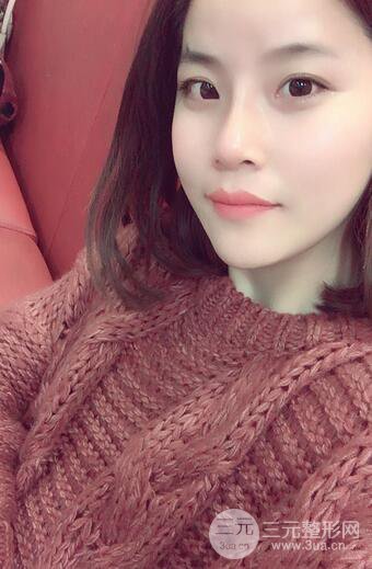 隆鼻鼻翼缩小全过程和术后照片分享，随意揉捏很OK