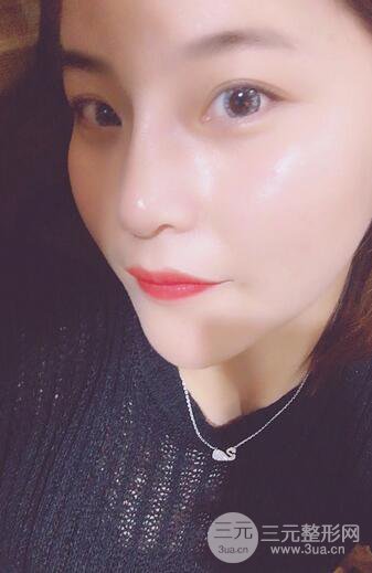 隆鼻鼻翼缩小全过程和术后照片分享，随意揉捏很OK