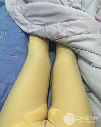 上海九院张余光大腿吸脂+臀部吸脂，恢复过程案例分享~