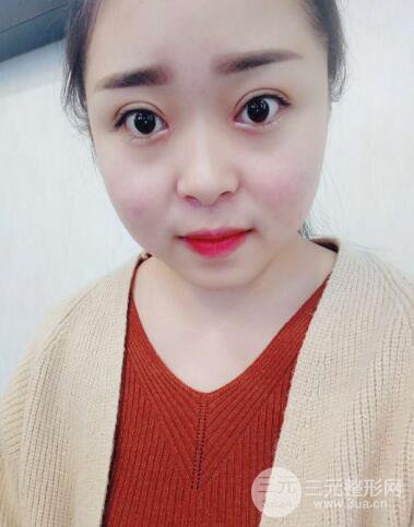 山西大医院杨时昕双眼皮案例日记分享