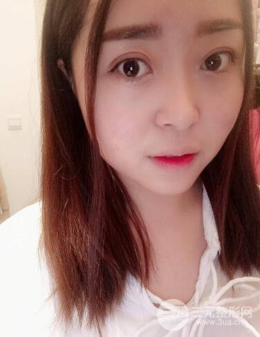 山西大医院杨时昕双眼皮案例日记分享