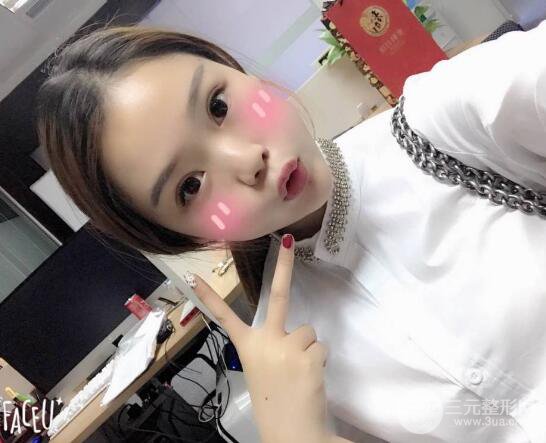 福建省人民医院钟盛全双眼皮案例记录分享