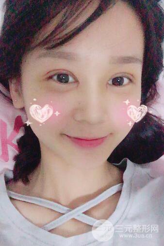 芭比电双眼皮多项整形术后分享，双眼皮拯救死鱼眼！