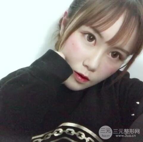 自体脂肪填充全脸基本换脸，改脸型不只是磨骨才能做到！