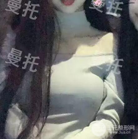 分享我的曼托隆胸图片