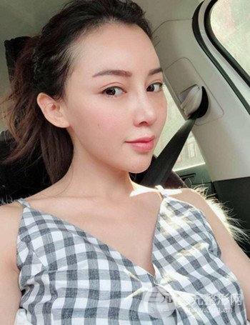 上海隆鼻失败手术修复果超乎想象、前后对比照片分享