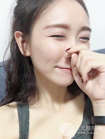 面部埋埋蛋白线.提升改良皮肤松弛，立现小V脸