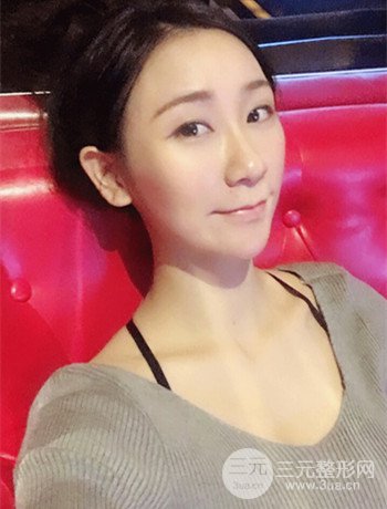 面部埋埋蛋白线.提升改良皮肤松弛，立现小V脸