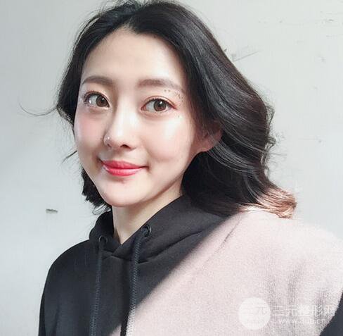 【肋软骨隆鼻+歪鼻矫正案例】降低风险无排异，可随意揉捏