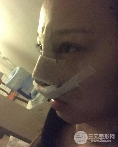 武汉美仑陈远海假体隆鼻案例，恢复过程分享~