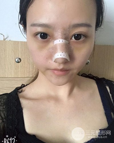 武汉美仑陈远海假体隆鼻案例，恢复过程分享~