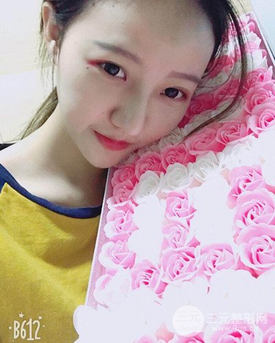 武汉美仑陈远海假体隆鼻案例，恢复过程分享~