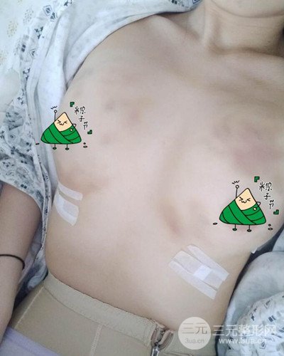 武汉同济自体脂肪隆胸案例，恢复过程前后对比图分享~