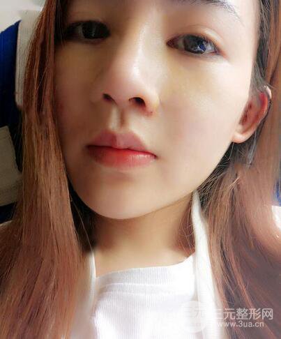 耳软骨隆鼻全过程及术后果分享，亲身体验~