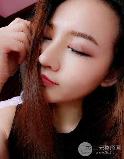 耳软骨隆鼻全过程及术后果分享，亲身体验~