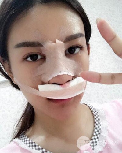南京华美沈正宇假体隆鼻恢复过程前后对比图分享~