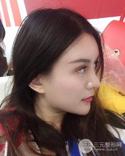 南京华美沈正宇假体隆鼻恢复过程前后对比图分享~