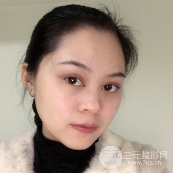 广州激光祛雀斑果不反弹、恢复过程图片分享