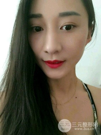 朱彤玥激光祛斑案例、两个月果对比超明X