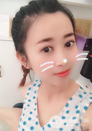 邢台陈誉华双眼皮整形案例日记分享
