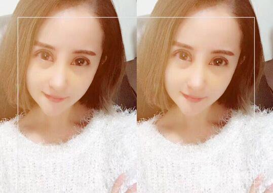 硅胶隆鼻术前术后对比照片分享，走上颜值顶峰