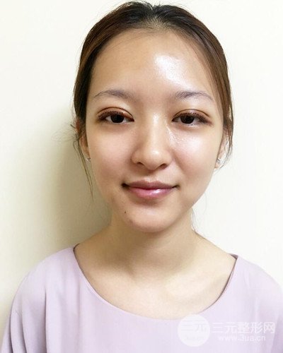 深圳蒳美迩黄海彬双眼皮案例恢复过程对比图分享~