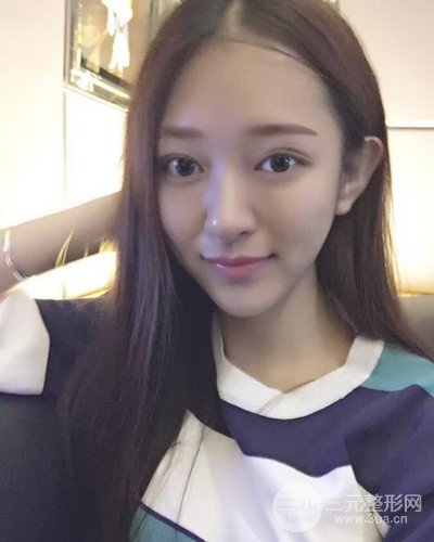 深圳蒳美迩黄海彬双眼皮案例恢复过程对比图分享~